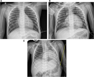 Case report: Foreign body aspiration requiring extracorporeal membrane oxygenation